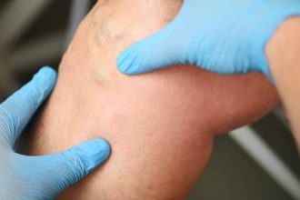 Consultation d'un patient pour des varices et insuffisance veineuse